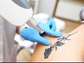 laser tattoo removal clinic
